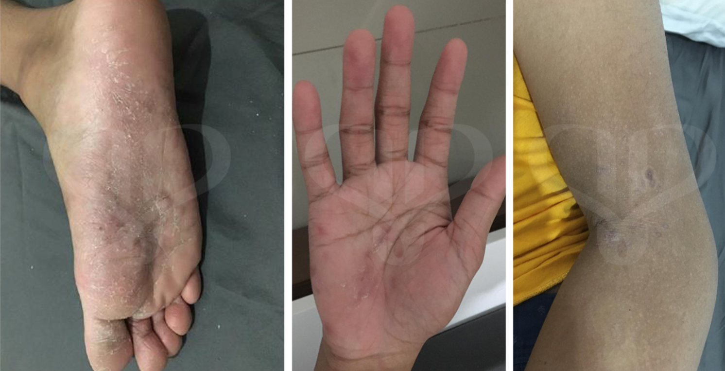 Kondisi perubahan pasien palmo-plantar pustula psoriasis